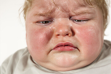 Close-up of a young child with serious facial expression and flushed cheeks.