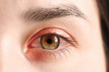 Obraz premium Conjunctivitis. Young woman with infected eye, closeup