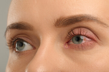 Naklejka premium Conjunctivitis. Young woman with infected eye, closeup