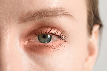 Conjunctivitis. Young woman with infected eye, closeup
