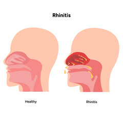 Nose Nasal diseases. Rhinitis symptoms and healthy nasal cavity. Allergy, rhinitis or cold medical diagram