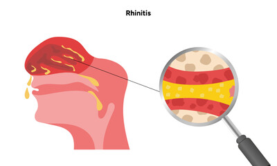 Nose Nasal diseases. Rhinitis symptoms. Allergy, rhinitis or cold medical diagram
