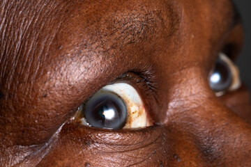 Patient showing symptoms of corneal ulcer affecting vision