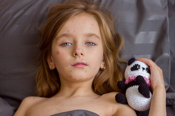 Little sad girl with a rash on her face and body lies in bed with a toy, chickenpox or measles virus in children	