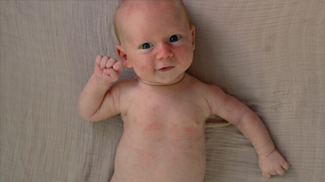 A newborn baby with visible rashes on his body, highlighting a common infant skin condition. A moment focused on neonatal care, skin health, and the importance of gentle treatment for newborns