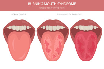 Burning mouth syndrome diseases. Oral medisine. Medical infographic design. Vector illustration