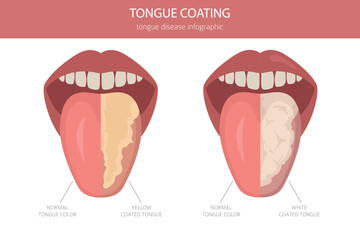 Tongue coating. Oral medicine. White tongue, yellow coated tongue disease. Medical infographic design. Vector illustration