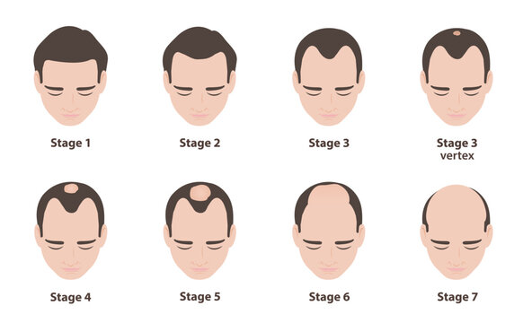 Infographic of the norwood scale for male pattern baldness illustration on white background. Androgenetic alopecia is a type of hair loss that affects men, seven stages of male pattern baldness.