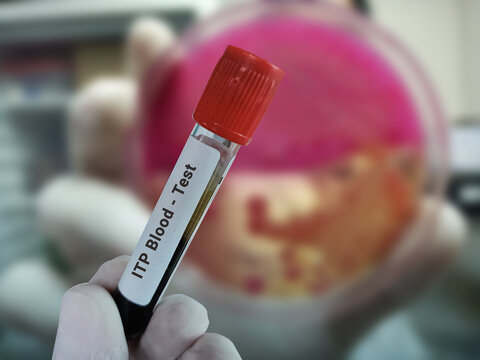Biochemist or Scientist holds blood sample for ITP Blood (Immune Thrombocytopenic Purpura) test. Medical test tube in laboratory background.
