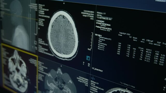 Panning closeup of computer screen with MRI scan of patient brain and scull in axial, sagittal sections, on desk of radiology specialist at neurosurgery clinical during examination procedure