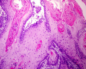 Human skin. Squamous cell carcinoma