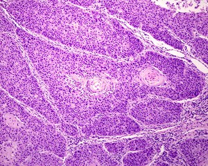 Human skin. Squamous cell carcinoma