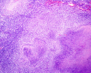 Human lymph node. Tuberculous lymphadenitis