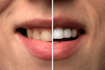 Woman smiling before and after procedure dental veneers placement, closeup. Aesthetic improvement of teeth, collage