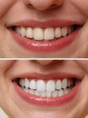 Fototapeta premium Woman smiling before and after procedure dental veneers placement, closeup. Aesthetic improvement of teeth, collage