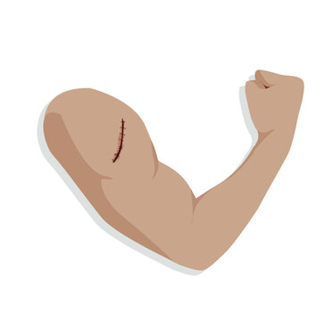 arm with scar, flexing, tan skin clip art preview