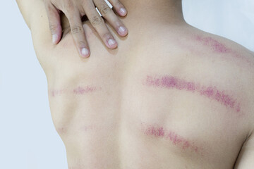 Back view of a man touching his shoulder, revealing lines of bruising and redness on his skin....