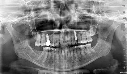 3D panoramic X-ray image of an adult female's teeth with dental implant x-ray image