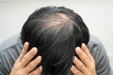 Fototapeta premium Bald head in man, hair loss treatment health problem.