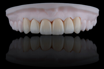 High-quality six dental crowns made of zirconium for fixation to the frontal teeth of upper jaw.