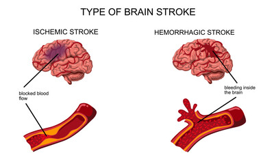 Brain stroke, hemorrhagic and ischemic. Arteriosclerosis, infarct, ischemia, thrombosis disease. Cholesterol in human blood vessels. Medical poster vector illustration.
