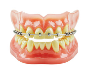 Dental model with braces illustrating orthodontic treatment for improved alignment and smile enhancement, cut out