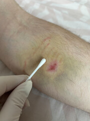 A gloved hand holds a cotton swab, gently cleaning a bruise on a forearm covered with...