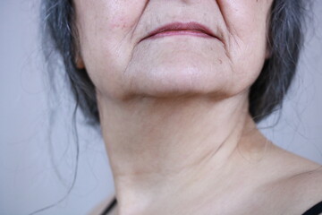 Nasolabialfalten, Marionettenfalten, Hängebäckchen, alte Frau