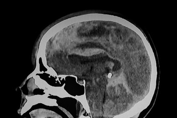 Medical themes: CAT Scan of severo skull brain trauma