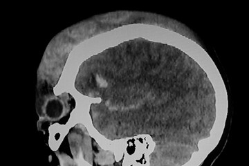 Medical themes: CAT Scan of severo skull brain trauma
