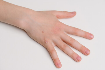 Multiple warts on child's hand lying on white table, close-up. Verruca vulgaris. Flat wart, caused by human papillomavirus HPV. Wart removal concept