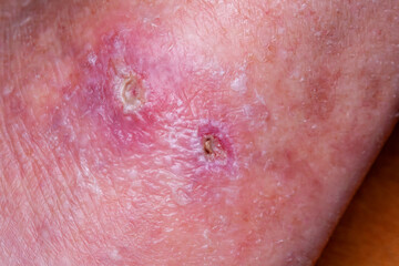 Fototapeta premium Inflamed wound in healing process