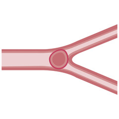 embolism colored ico