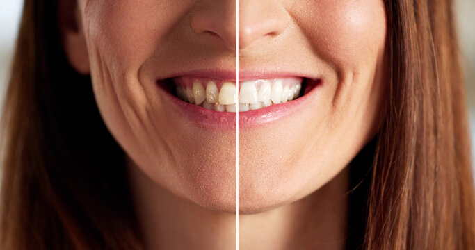 Dental procedure transforms smiling woman's teeth from stained