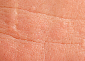 A close up of a hand with a red rash on it