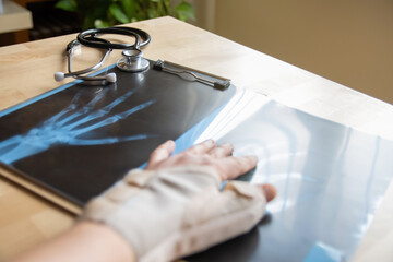 Doctor examining a hand x-ray following a workplace accident, assessing aspects of health insurance, sick leave, and traumatology related to the injury and treatment options