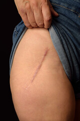 Minimally invasive anterolateral total hip replacement, 40 months later