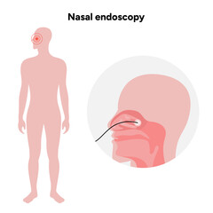 Nasal endoscopy procedure nasal and sinus passages. Thin, flexible tube with camera and light. Ear, nose, and throat. Medical diagram