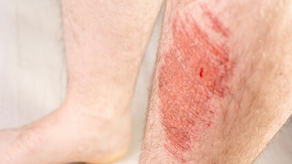 Man's leg is covered in red marks and bruises. The leg is also covered in hair