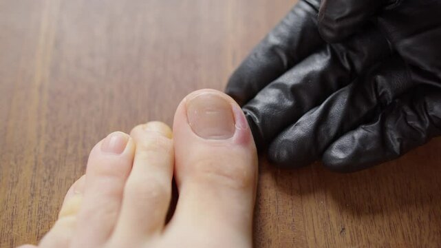Patient's toe infection gets checked by doctor with black glove, close-up on toe