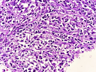Mixed cellularity classic Hodgkin lymphoma (MCCHL), a subtype of classic Hodgkin lymphoma characterized by Hodgkin, Reed Sternberg cells in a diffuse mixed inflammatory background