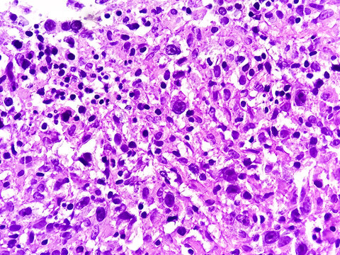 Mixed cellularity classic Hodgkin lymphoma (MCCHL), a subtype of classic Hodgkin lymphoma characterized by Hodgkin, Reed Sternberg cells in a diffuse mixed inflammatory background