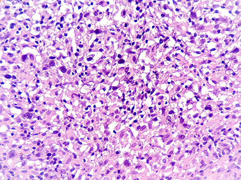 Mixed cellularity classic Hodgkin lymphoma (MCCHL), a subtype of classic Hodgkin lymphoma characterized by Hodgkin, Reed Sternberg cells in a diffuse mixed inflammatory background