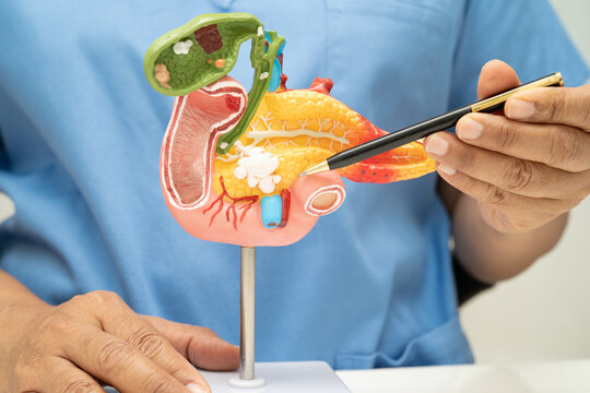 Pancreatitis, pancreatic cancer, Asian doctor with pancreas, gallbladder and bile duct human anatomy model at hospital.