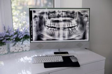 A monitor displays a panoramic image of the upper and lower jaw, highlighting the dental structures. This visual tool aids in diagnosis and treatment planning for dental professionals. © Олег Онікієнко
