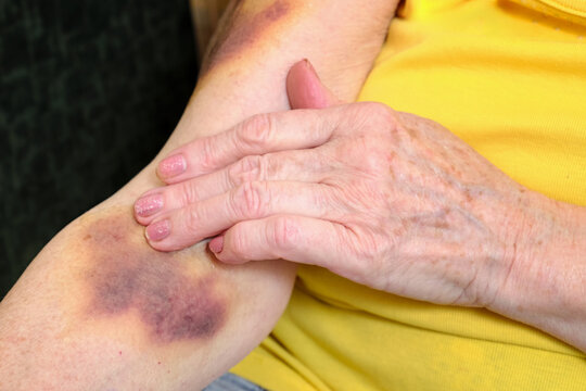 An adult woman holds hand near a hematoma on her arm after an injury.