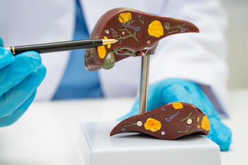 Cirrhosis, Liver cancer, fatty liver, Asian doctor with liver human anatomy model in World Hepatitis Day at hospital.
