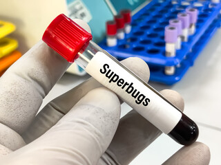 Biological specimen (blood) for Superburgs test at medical laboratory.