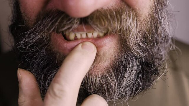 Bearded moustache man with bad teeth caused by smoking. People with dental problem