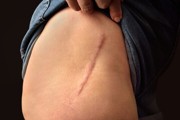 Total hip replacement, 40 months later, woman 60